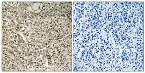 Immunohistochemical analysis of paraffin-embedded human breast carcinoma tissue using Anti-RPL40 Antibody. The right hand panel represents a negative control, where the antibody was pre-incubated with the immunising peptide