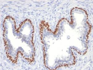 Immunohistochemical analysis of formalin-fixed, paraffin-embedded human prostate cancer using Anti-p63 Antibody [TP63/11]