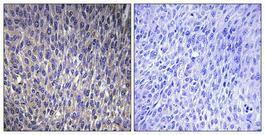 Immunohistochemical analysis of paraffin-embedded human lung cancer using Anti-RPL40 Antibody 1:100 (4°C overnight). The right hand panel represents a negative control, where the antibody was pre-incubated with the immunising peptide