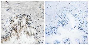 Immunohistochemical analysis of paraffin-embedded human prostate carcinoma tissue using Anti-RPL31 Antibody. The right hand panel represents a negative control, where the Antibody was pre-incubated with the immunising peptide