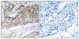 Immunohistochemical analysis of paraffin-embedded human breast carcinoma tissue using Anti-DHRS11 Antibody. The right hand panel represents a negative control, where the antibody was pre-incubated with the immunising peptide.