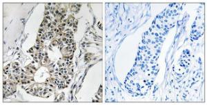 Immunohistochemical analysis of paraffin-embedded human breast carcinoma tissue using Anti-RIMS4 Antibody. The right hand panel represents a negative control, where the antibody was pre-incubated with the immunising peptide