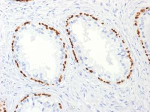 Immunohistochemical analysis of formalin-fixed, paraffin-embedded human prostate carcinoma using Anti-p63 Antibody [TP63/2427]