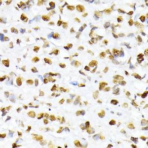 Immunohistochemistry analysis of paraffin-embedded human breast cancer tissue using Anti-Histone H2A (phospho Ser129) Antibody (A306364) at a dilution of 1:100 (40X lens)