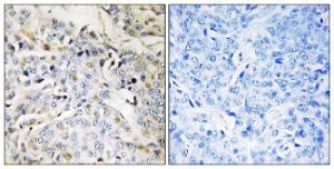 Immunohistochemical analysis of paraffin-embedded human breast carcinoma tissue using Anti-RBM34 Antibody. The right hand panel represents a negative control, where the antibody was pre-incubated with the immunising peptide