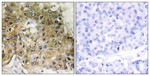 Immunohistochemical analysis of paraffin-embedded human breast carcinoma using Anti-Integrin beta1 (phospho Thr789) Antibody. The right hand panel represents a negative control, where the antibody was pre-incubated with the immunising peptide