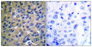 Immunohistochemical analysis of paraffin-embedded human breast carcinoma using Anti-IkappaB-epsilon (phospho Ser22) Antibody The right hand panel represents a negative control, where the antibody was pre-incubated with the immunising peptide