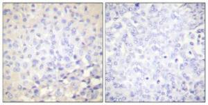 Immunohistochemical analysis of paraffin-embedded human breast cancer using Anti-IkappaB-epsilon (phospho Ser22) Antibody 1:100 (4°C overnight) The right hand panel represents a negative control, where the antibody was pre-incubated with the immunising peptide