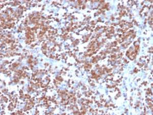 Immunohistochemical analysis of formalin-fixed, paraffin-embedded human mantle cell lymphoma using Anti-Cyclin D1 Antibody [CCND1/3370R]