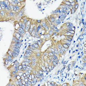 Immunohistochemistry analysis of paraffin-embedded human colon carcinoma tissue using Anti-DR5 Antibody [ARC0406] (A305494) at a dilution of 1:100 (40X lens). Perform microwave antigen retrieval with 10 mM PBS buffer pH 7.2 before commencing with IHC staining protocol