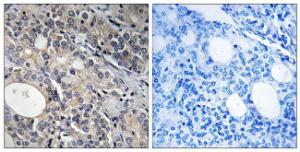 Immunohistochemical analysis of paraffin-embedded human prostate carcinoma tissue using Anti-RPL17 Antibody. The right hand panel represents a negative control, where the antibody was pre-incubated with the immunising peptide