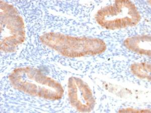 Immunohistochemical analysis of formalin-fixed, paraffin-embedded human endo-cervical carcinoma using Anti-IL-10 Antibody [IL10/2651R]