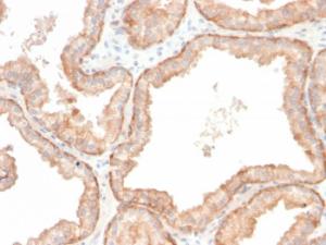 Immunohistochemical analysis of formalin-fixed, paraffin-embedded human prostate carcinoma using Anti-IL-10 Antibody [IL10/2651R]