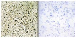 Immunohistochemical analysis of paraffin-embedded human prostate carcinoma tissue using Anti-RHG07 Antibody. The right hand panel represents a negative control, where the Antibody was pre-incubated with the immunising peptide