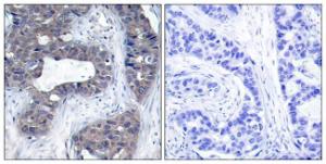 Immunohistochemical analysis of paraffin-embedded human breast carcinoma tissue using Anti-IRS-1 Antibody. The right hand panel represents a negative control, where the antibody was pre-incubated with the immunising peptide