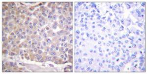 Immunohistochemical analysis of paraffin-embedded human breast carcinoma tissue using Anti-IRS-1 Antibody. The right hand panel represents a negative control, where the antibody was pre-incubated with the immunising peptide