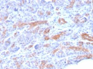 Immunohistochemical analysis of formalin-fixed, paraffin-embedded human pancreatic carcinoma using Anti-MRP3 Antibody [ABCC3/2971]