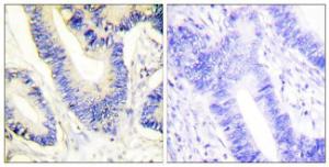 Immunohistochemical analysis of paraffin-embedded human colon carcinoma tissue using Anti-IRS-1 Antibody. The right hand panel represents a negative control, where the antibody was pre-incubated with the immunising peptide.