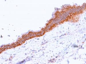 Immunohistochemical analysis of formalin-fixed, paraffin-embedded human pancreatic carcinoma using Anti-MRP3 Antibody [ABCC3/2971]