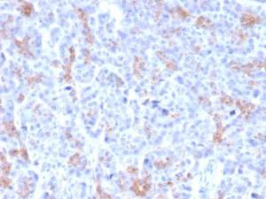 Immunohistochemical analysis of formalin-fixed, paraffin-embedded human pancreatic carcinoma using Anti-MRP3 Antibody [ABCC3/2971]