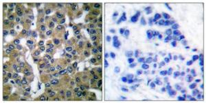 Immunohistochemical analysis of paraffin-embedded human breast carcinoma tissue using Anti-PLCG2 Antibody. The right hand panel represents a negative control, where the antibody was pre-incubated with the immunising peptide