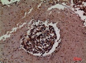 Immunohistochemical analysis of paraffin-embedded human lung cancer using Anti-ICAM3 Antibody