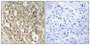 Immunohistochemical analysis of paraffin-embedded human breast carcinoma using Anti-NF-kappaB p65 (phospho Ser529) Antibody. The right hand panel represents a negative control, where the antibody was pre-incubated with the immunising peptide.