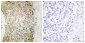 Immunohistochemical analysis of paraffin-embedded human breast carcinoma tissue using Anti-HSP20 Antibody. The right hand panel represents a negative control, where the Antibody was pre-incubated with the immunising peptide