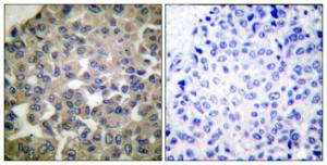 Immunohistochemical analysis of paraffin-embedded human breast carcinoma tissue using Anti-PLCG1 Antibody The right hand panel represents a negative control, where the antibody was pre-incubated with the immunising peptide