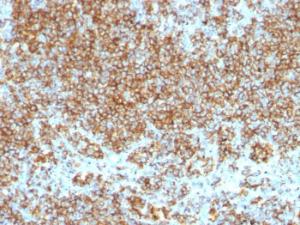 Immunohistochemical analysis of formalin-fixed, paraffin-embedded human lymphoma using Anti-CD45 Antibody [SPM569 + SPM570]