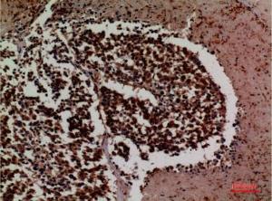 Immunohistochemical analysis of paraffin-embedded human lung cancer using Anti-ICAM3 Antibody