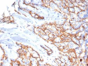 Immunohistochemical analysis of formalin-fixed, paraffin-embedded human papillary renal cell carcinoma using Anti-CD133 Antibody [HB#7]