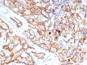 Immunohistochemical analysis of formalin-fixed, paraffin-embedded human papillary renal cell carcinoma using Anti-CD133 Antibody [HB#7]