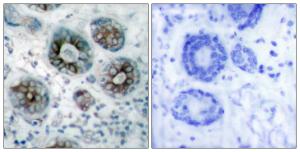 Immunohistochemical analysis of paraffin-embedded human breast carcinoma tissue using Anti-GAP43 Antibody The right hand panel represents a negative control, where the antibody was pre-incubated with the immunising peptide