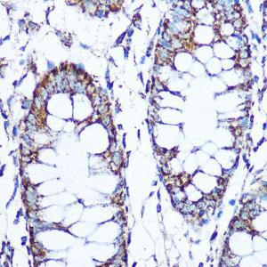 Immunohistochemistry analysis of paraffin-embedded human colon tissue using Anti-SOD2/MnSOD Antibody (A306407) at a dilution of 1:100 (40x lens) Perform microwave antigen retrieval with 10 mM Tris/EDTA buffer pH 90 before commencing with IHC staining protocol