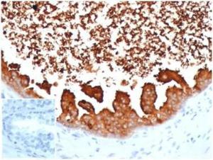 Immunohistochemical analysis of formalin-fixed, paraffin-embedded human prostate carcinoma tissue using Anti-Lactoferrin Antibody [LTF/4075]. Inset: PBS instead of the primary Antibody. Secondary Antibody negative control