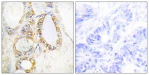 Immunohistochemical analysis of paraffin-embedded human colon carcinoma tissue using Anti-MUC13 Antibody. The right hand panel represents a negative control, where the antibody was pre-incubated with the immunising peptide.