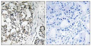 Immunohistochemical analysis of paraffin-embedded human breast carcinoma tissue using Anti-PEX14 Antibody. The right hand panel represents a negative control, where the Antibody was pre-incubated with the immunising peptide