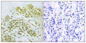 Immunohistochemical analysis of paraffin-embedded human breast carcinoma using Anti-IkappaB-alpha (phospho Tyr42) Antibody. The right hand panel represents a negative control, where the Antibody was pre-incubated with the immunising peptide