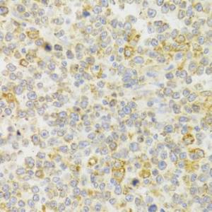 Immunohistochemistry analysis of paraffin-embedded human B cell lymphoma tissue using Anti-GPR54 Antibody (A11590) at a dilution of 1:100 (40X lens). Perform microwave antigen retrieval with 10 mM PBS buffer pH 7.2 before commencing with IHC staining protocol