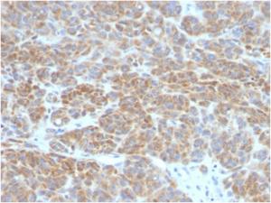 Immunohistochemical analysis of formalin-fixed, paraffin-embedded human melanoma using Anti-Bcl-2 Antibody [BCL2/782]