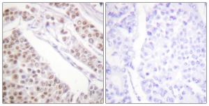 Immunohistochemical analysis of paraffin-embedded human lung carcinoma tissue using Anti-Histone H2B (acetyl Lys12) Antibody. The right hand panel represents a negative control, where the Antibody was pre-incubated with the immunising peptide