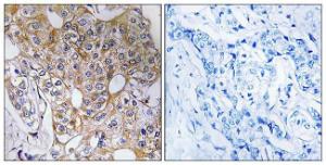 Immunohistochemical analysis of paraffin-embedded human breast carcinoma tissue using Anti-CCT6A Antibody. The right hand panel represents a negative control, where the antibody was pre-incubated with the immunising peptide