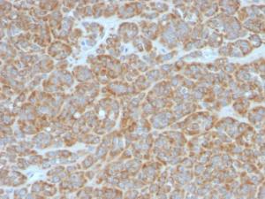 Immunohistochemical analysis of formalin-fixed, paraffin-embedded human melanoma using Anti-Bcl-2 Antibody [BCL2/796]