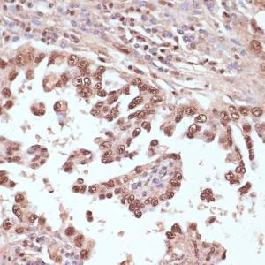 Immunohistochemistry analysis of paraffin-embedded human lung cancer using Anti-Rad50 Antibody (A11606) at a dilution of 1:100 (40x lens). Perform microwave antigen retrieval with 10 mM PBS buffer pH 7.2 before commencing with IHC staining protocol.