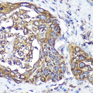 Immunohistochemistry analysis of paraffin-embedded human lung cancer using Anti-ANKLE2 Antibody (A305517) at a dilution of 1:100 (40x lens)