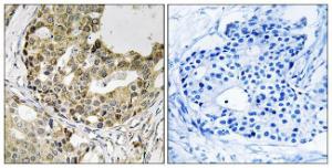 Immunohistochemical analysis of paraffin-embedded human breast carcinoma tissue using Anti-NXPH1 Antibody. The right hand panel represents a negative control, where the antibody was pre-incubated with the immunising peptide