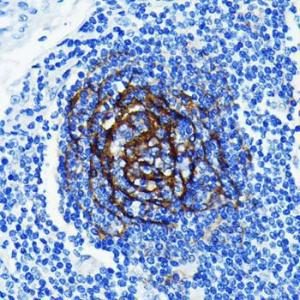 Immunohistochemistry analysis of paraffin-embedded human lung cancer using Anti-p75 NGF Receptor Antibody [ARC0284] (A306428) at a dilution of 1:100 (40X lens). Perform microwave antigen retrieval with 10 mM PBS buffer pH 7.2 before commencing with IHC staining protocol