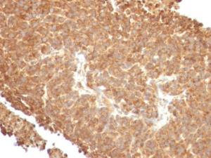 Immunohistochemical analysis of formalin-fixed, paraffin-embedded human melanoma using Anti-TOP1MT Antibody [TOP1MT/488]