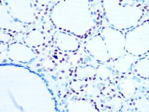 Immunohistochemistry analysis of paraffin-embedded human thyroid cancer using Anti-Histone H10 Antibody [ARC1059] (A307908) at a dilution of 1:100 (40x lens) Perform microwave antigen retrieval with 10 mM PBS buffer pH 72 before commencing with IHC staining protocol